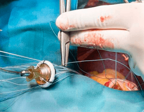 Cirugía Endovascular